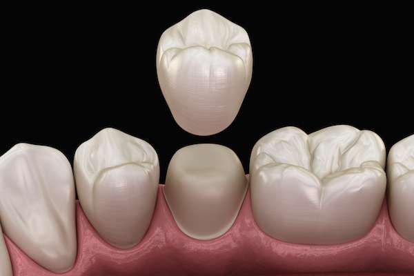 What To Ask Your General Dentist When Preparing for a Crown from Integrity Family Dental in Denver, CO