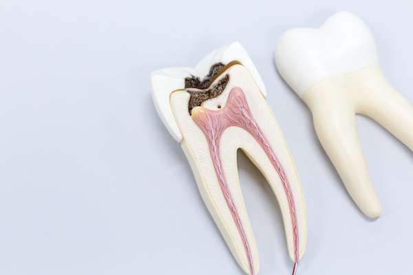 Ask a General Dentist: Is a Tooth Dead After a Root Canal from Integrity Family Dental in Denver, CO