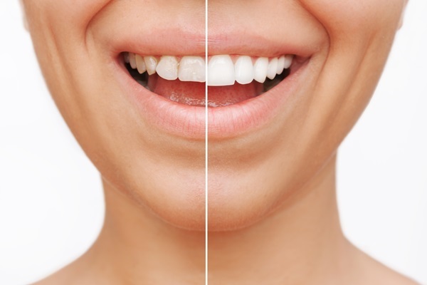 How A Cosmetic Dentist Can Enhance Your Smile