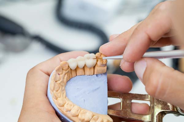 How Many Missing Teeth Can A Dental Bridge Replace Integrity Family 